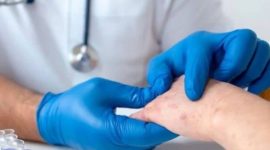 Gejala cacar monyet biasanya muncul 2-4 minggu setelah terpapar virus.